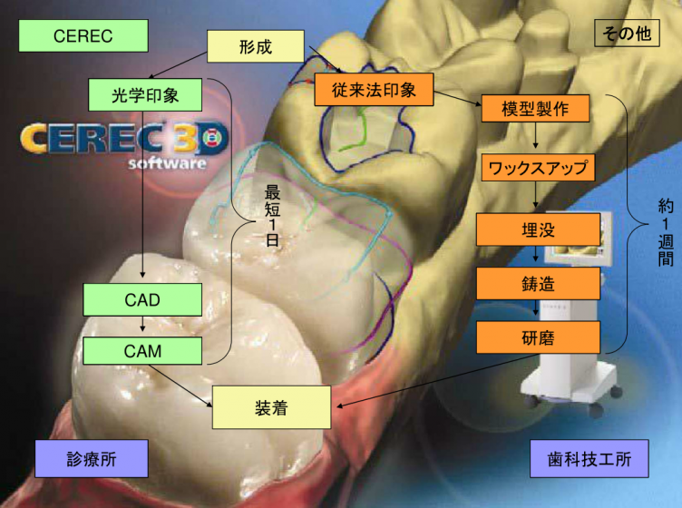 CEREC 光学印象システムでスピードアップ