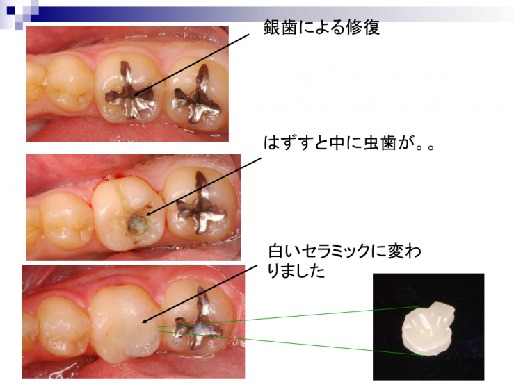 銀歯による修復をセラミックに変えると