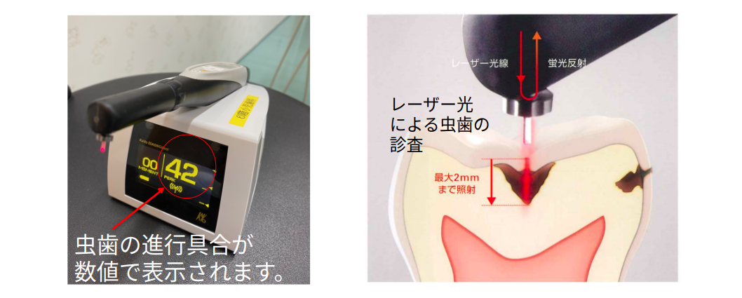 レーザー診査