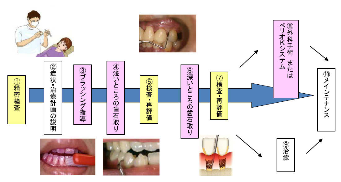 歯周病の治療の流れ