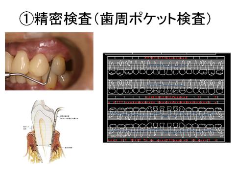 歯の周囲の歯肉には、歯を取り囲むようにポケット(溝)があります。このポケットは健康な歯肉にもあり、その深さの正常値は3ミリです。このポケットは一種のバリアーの役目をはたしており、体にとって必要なものですが、このポケットが深くなること=歯周病が進行しているということを意味します。一緒に歯の動揺度（骨の支持に関連），出欠の有無（炎症の有無），分岐部病変の有無（奥歯の股の間の骨吸収）などについて検査します。