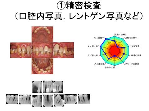 プラークに色をつけて目に見えるようにします。赤くなっているのがプラークです。歯ブラシをどのようにあててプラークをしっかりおとすのかを指導します。必要に応じてフロス（糸ようじ）や歯間ブラシの使い方も説明します。