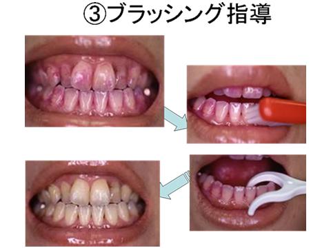 プラークに色をつけて目に見えるようにします。赤くなっているのがプラークです。歯ブラシをどのようにあててプラークをしっかりおとすのかを指導します。必要に応じてフロス（糸ようじ）や歯間ブラシの使い方も説明します。