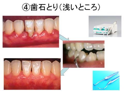 歯肉の周りに付着している白い硬いものが歯肉縁上の歯石です。これは歯ブラシでは除去できないので、超音波スケーラーか手用スケーラーで除去します。