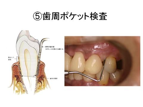 全体のプラークの除去や歯肉縁上の歯石除去が終了したら、再度ポケット検査を行います。歯周病も軽度のものなら、プラークと歯石の除去で改善します。