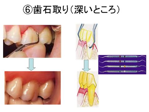 2回目のポケット検査で改善の見られなかった部位には歯肉縁下に歯石があるのでスケーリングルートプレーニングを行い汚染物質の除去ならびに歯面を滑沢にします。