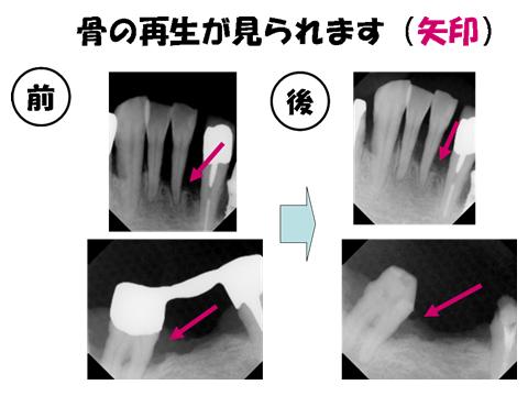 レントゲンでも歯を支える骨（歯槽骨）が回復してきています。