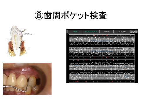 歯肉縁下の歯石除去を行ったら再度ポケット検査を行います。歯周病も中等度ならここで改善がみられます。