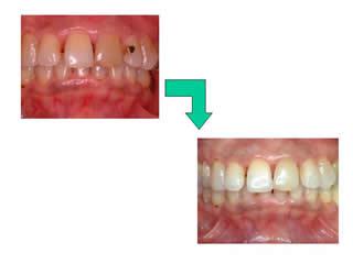 これは、毎日就寝時に漂白の薬をトレーにぬって、歯に装着します。これを3週間ほど続けますと、歯を削らずに白く輝く歯になっていきます。
