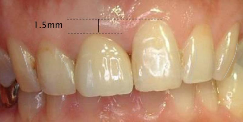 この図でわかるように、真ん中の歯はもともと高さが1.5mm違います。そこでインプラントを行う際は、見た目も以前より良いものを目指しました。
