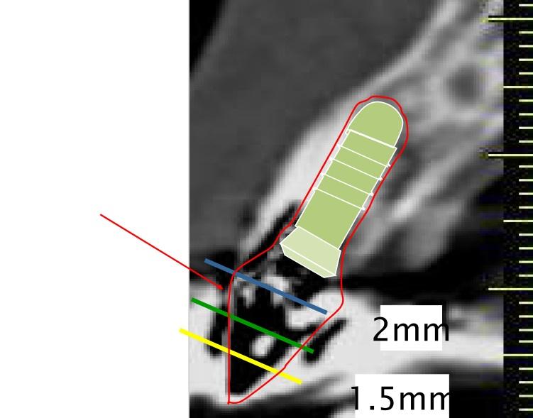 CT上で骨の位置、形を確認し、埋めるインプラントのイメージをあらかじめ作ります。