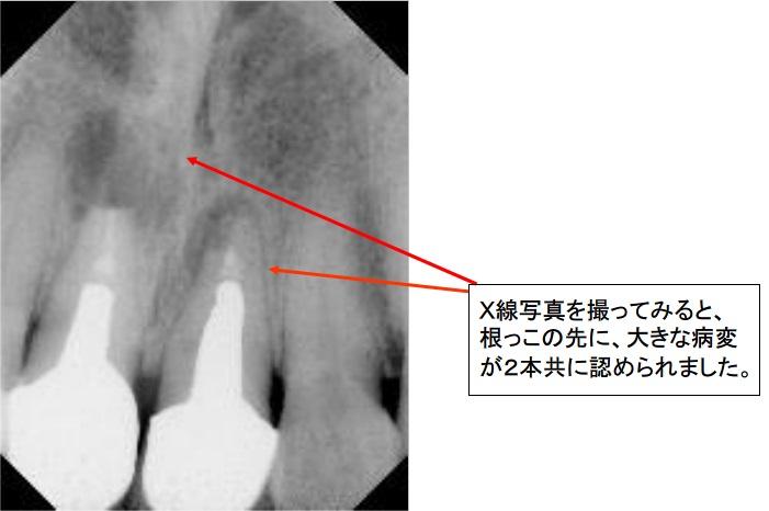 X線写真を撮ってみると、根っこの先に、大きな病変が２本共に認められました。