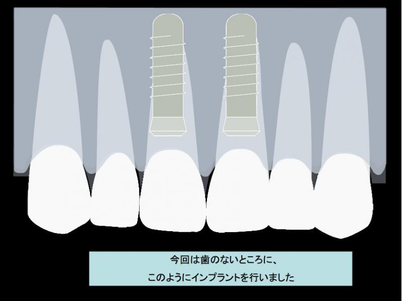 今回は歯のないところに、このようにインプラントを行いました。