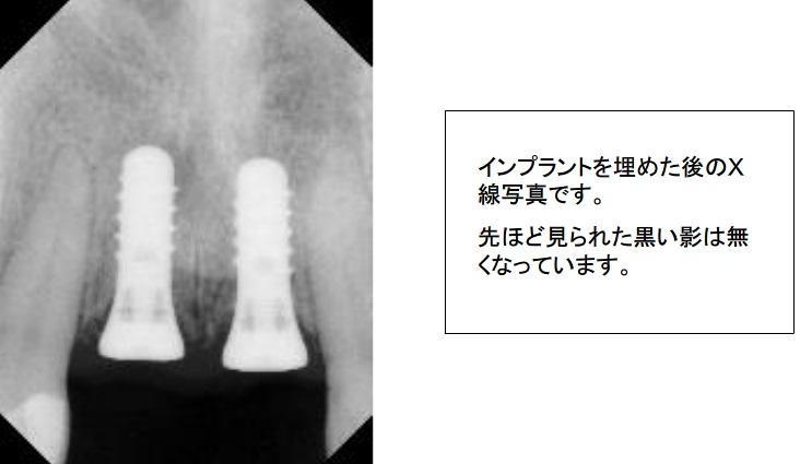 インプラントを埋めた後のX線写真です。先ほど見られた黒い陰は無くなっています。