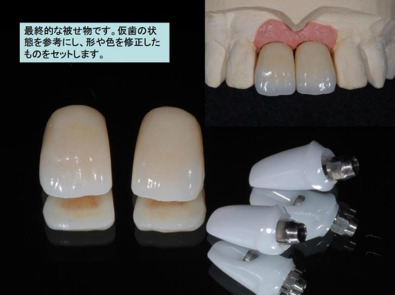 最終的な被せ物です。仮歯の状態を参考にし、形や色を修正したものをセットします。