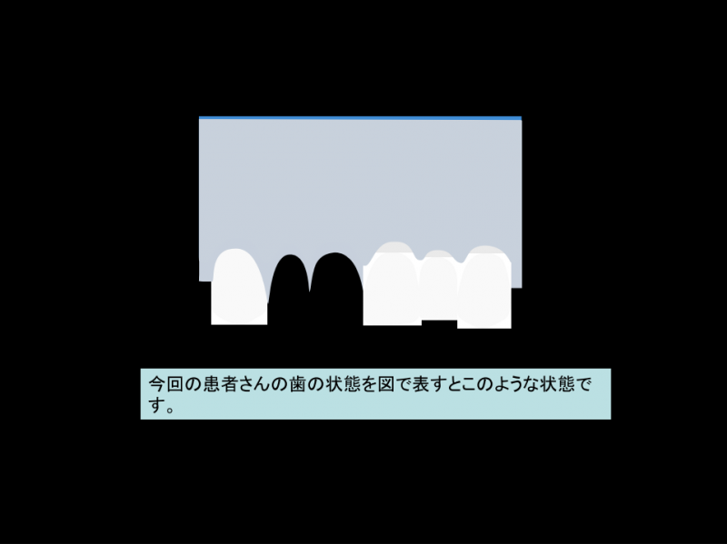 今回の患者さんの歯の状態を図で表すとこのような状態です。