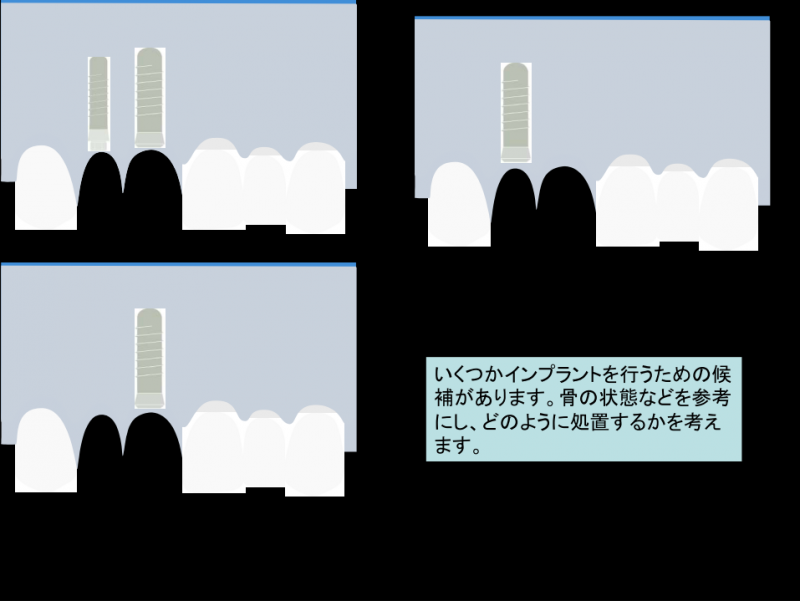 いくつかインプラントを行うための候補があります。骨の状態などを参考にし、どのように処置するかを考えます。