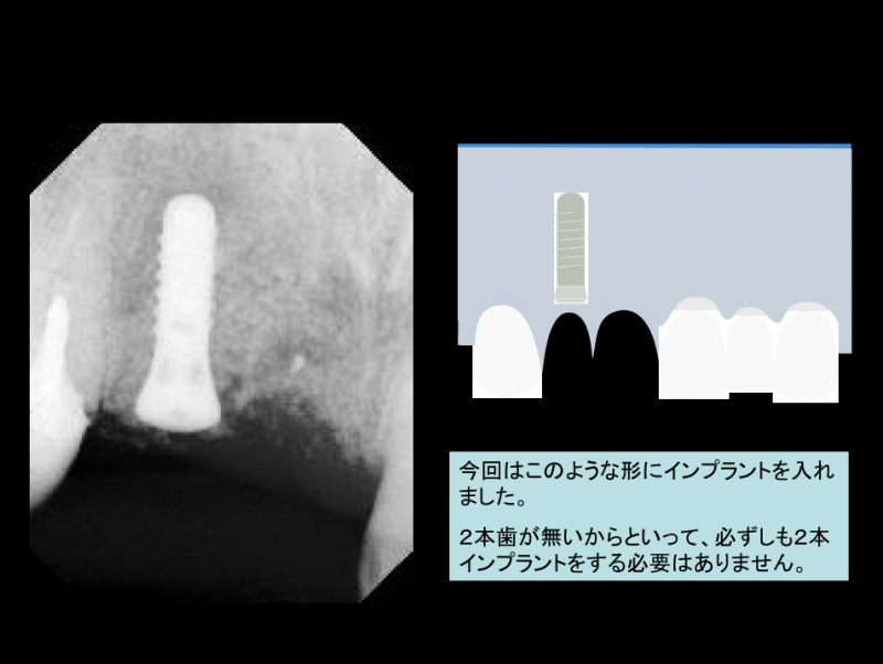 今回はこのような形にインプラントを入れました。２本歯が無いからといって、必ずしも２本インプラントをする必要はありません。