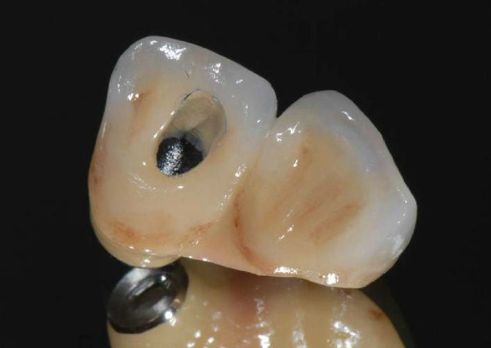 今回のインプラントの上にはこのような、まわりの歯の色などを再現した被せ物をセットすることになりました。
