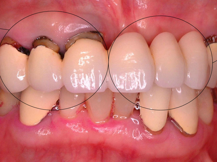 左の反対側を支えている歯は負担を受けており、根っこが露出してきています。右側にあるこれらの歯は一見きれいですが、人工的なもので、根っこはありません。