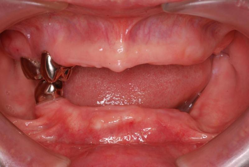 初診時の口の写真です。歯が３本しかありません。