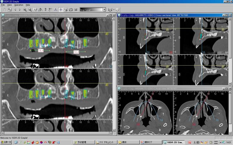 上の顎のどの位置にインプラントが入るか、CTという機械で三次元的に調べます。