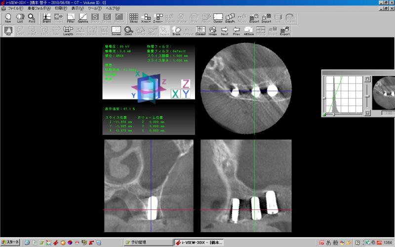 CTでインプラントの位置が問題ないか、三次元的に評価します。