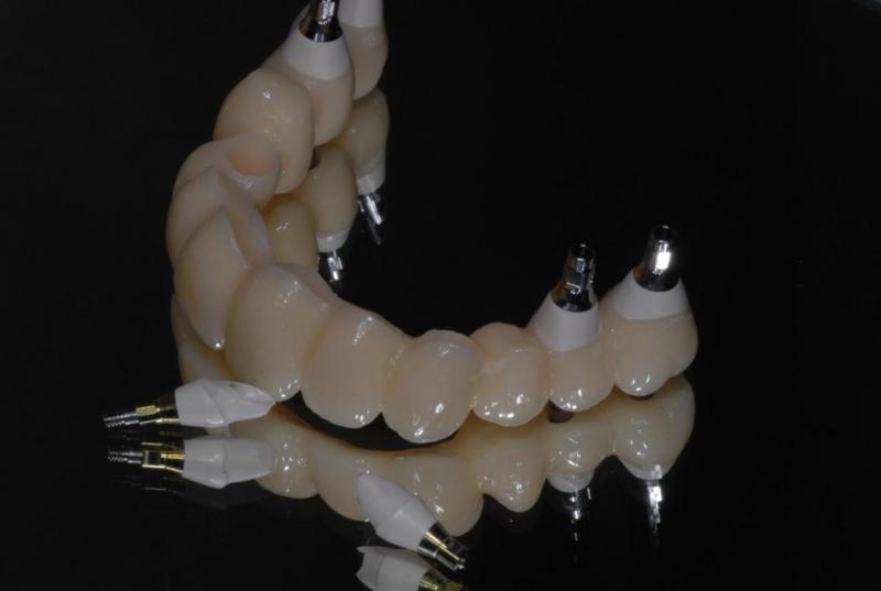 セラミックで作られた人工の歯です。