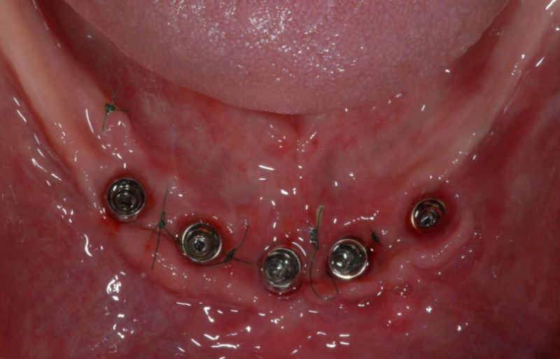 下の顎にもインプラントが入りました。