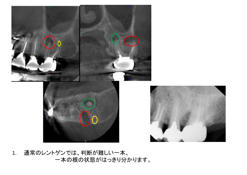 通常のレントゲンでは判断が難しい、一本、一本の根の状態がはっきり分かります。