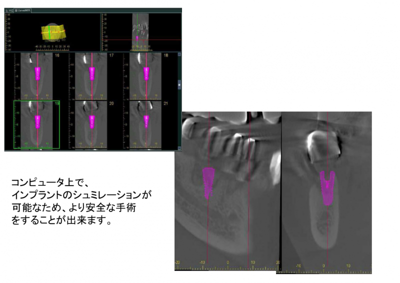 コンピュータ上でインプラントのシミュレーションが可能なため、より安全な手術をすることが出来ます。