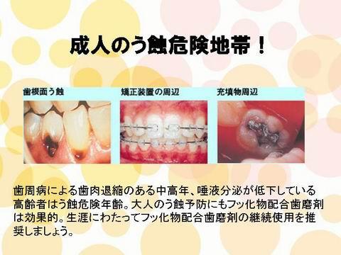 上の図は、成人の虫歯の危険地帯です。歯の根元や一度治療した歯の人工物と自分の歯の境目が危険度の高いところです。