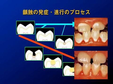 虫歯は、上野図のように進行します。歯の表層から始まって徐々に内部に進行します。