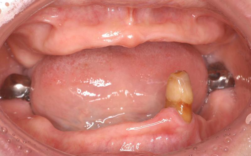 初診時のお口の写真です。上は歯が無く、下も3本しか残っていません。