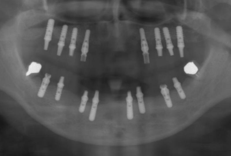 インプラントを入れた状態のレントゲン写真です。<br />上の顎にもインプラントを入れました。