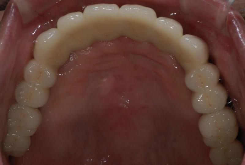 インプラントの上にセラミックの歯を装着しました。<br />入れ歯のような違和感はありません。