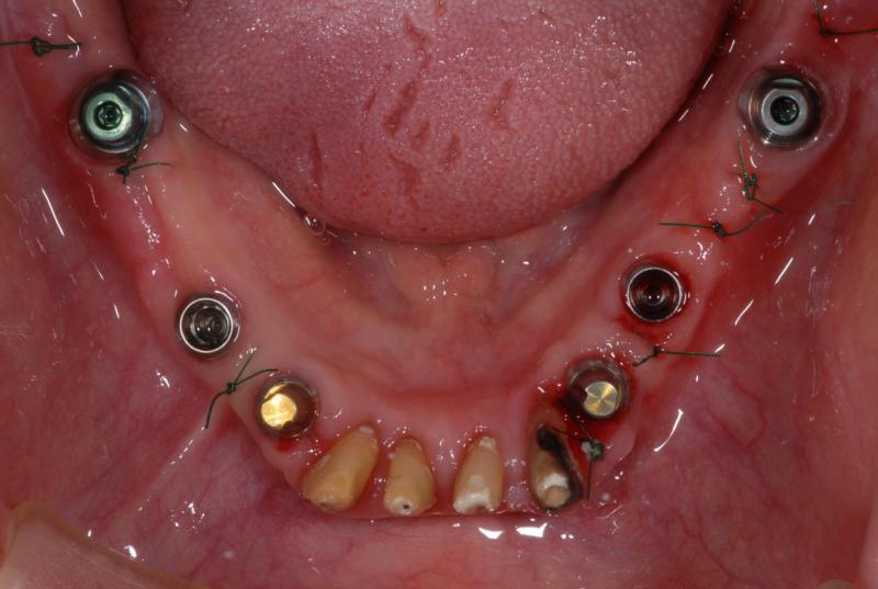 下の顎の奥歯にインプラントを入れて、二週間後の状態です。