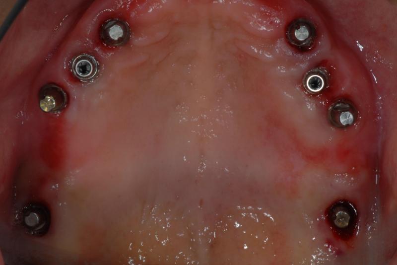 上の顎にも同様にインプラントを入れました。