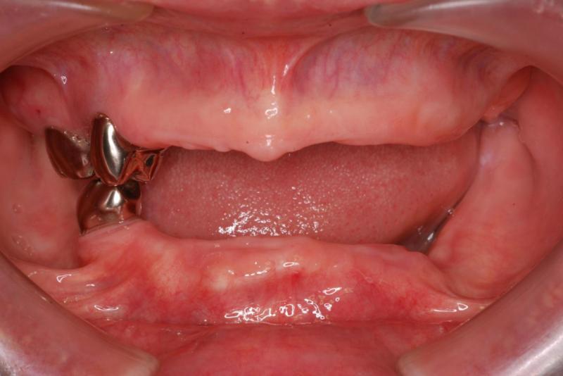 初診時の口の写真です。歯が3本しかありません。