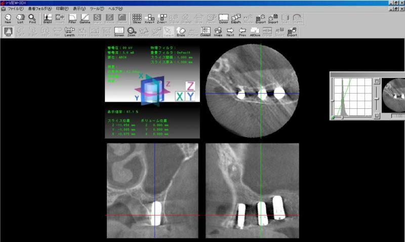 CTでインプラントの位置に問題がないか、3次元的に評価します。