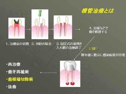 根の治療の、成功率は世界中のデーターを平均すると90％ぐらいと言われており、<br />１０％の歯に関して年数がたってから何らかの再治療が必要になるといわれています。