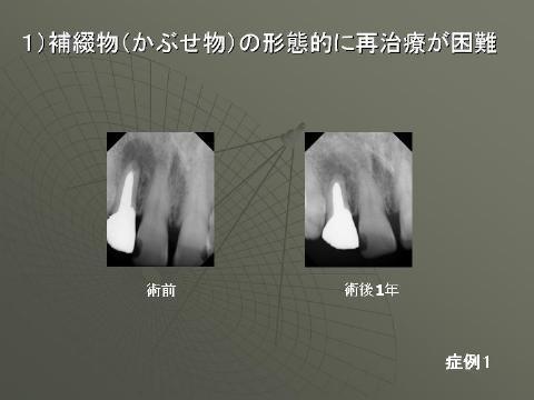 小樽熊澤歯科クリニックでの治療例をお見せします。