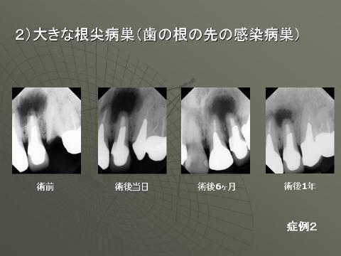 病巣が大きい場合骨の治癒にはかなりの時間がかかります。