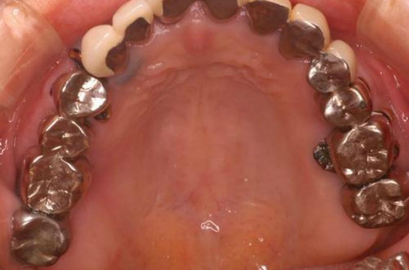 初診時の口腔内の写真です。冠が合ってない箇所があります。