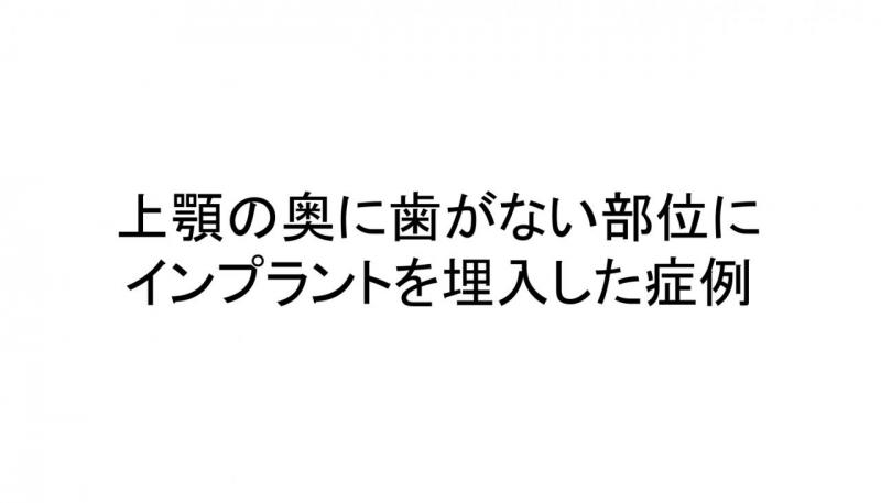 奥歯（上顎遊離端）にインプラントを行った症例です