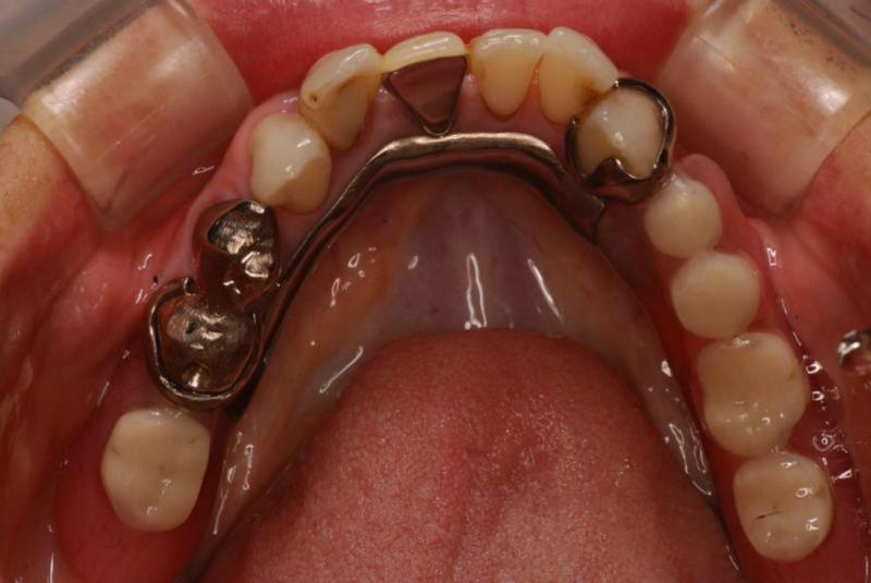 下の左右の奥歯に義歯が入っています。