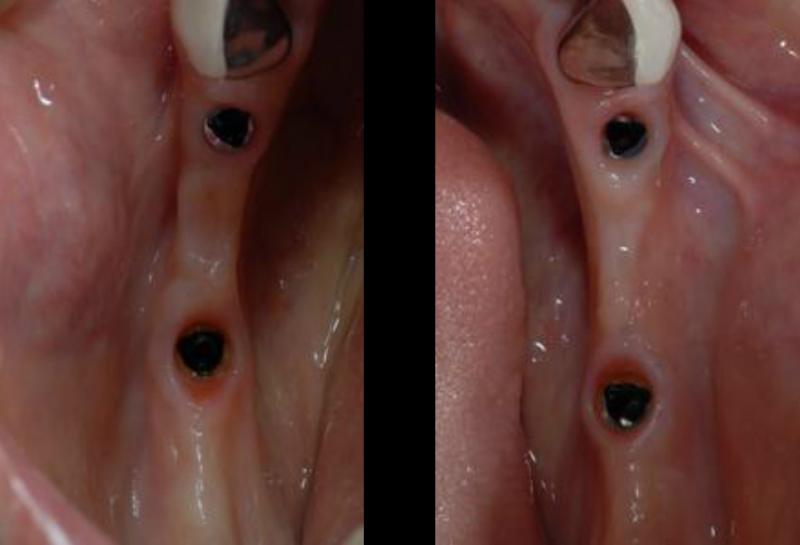 下の左右にそれぞれ2本のインプラントを埋入しました。