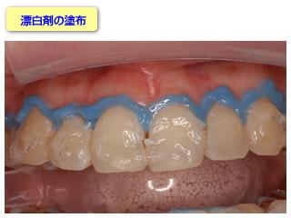 漂白剤を塗布します。この漂白剤はジェル状になっています。