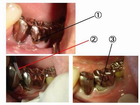 上の写真は、かぶせ物の境目にできた虫歯の治療に使用しているところです。?の部分を治療するのですが、歯茎の下のほうに虫歯が進んでおり、きちんとつめるには、冠を作り直すか、歯茎を切除して治療するか、、、、になります。　?は、レーザーで歯茎を蒸散させているところで、?が、つめて直したところです。従来の電気メスと違い止血効果も高く、何より傷の回復が早いのが特徴です。