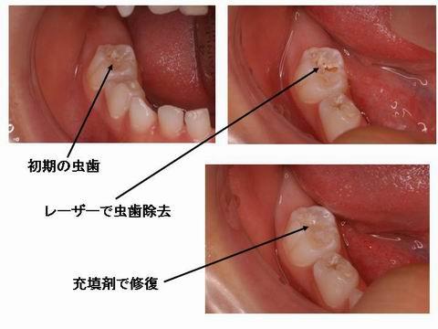 このスライドは、小児の虫歯の処置をレーザーで治療しているところです。　初期の虫歯であれば、麻酔もしないで歯も削らずに治療することができる場合もあります。